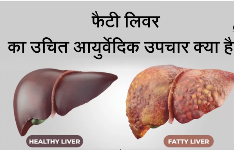 फैटी लीवर के लिए आयुर्वेदिक गाइड | Fatty Liver Ayurveda | Lifestyle Tips for Fatty Liver in Hindi